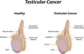 Testicular Cancer